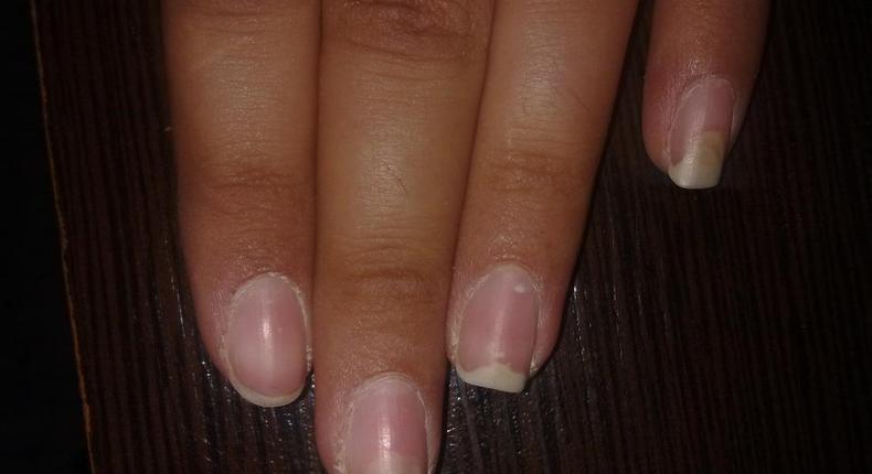 Causes and treatment of fingernails falling off