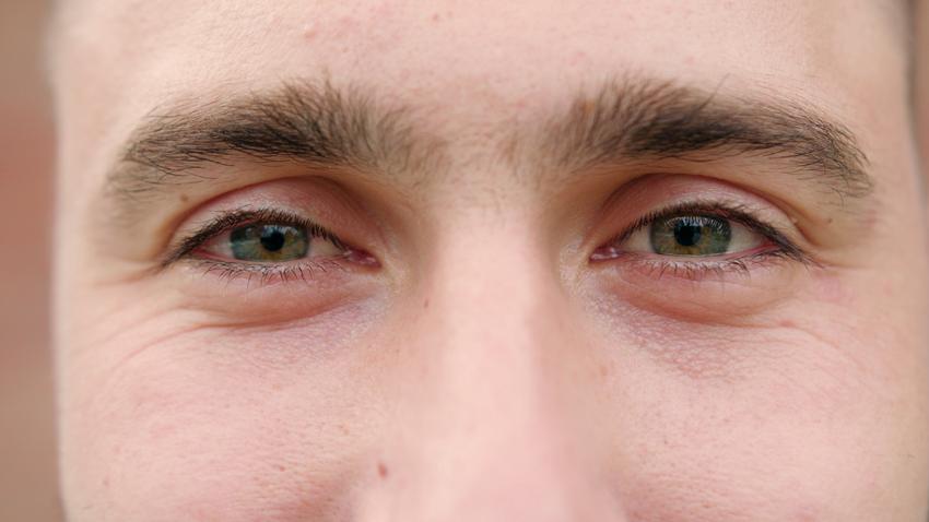 szénanátha allergia szem kötőhártya gyulladás tünet