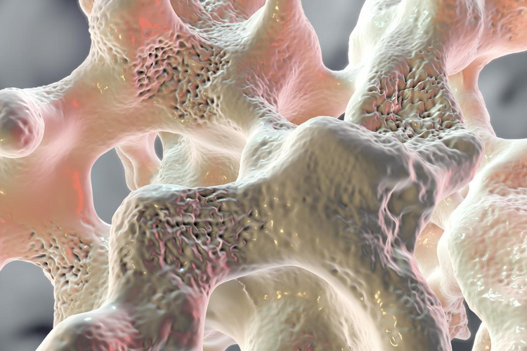 Osteoporoza, czyli choroba "dziurawych" kości