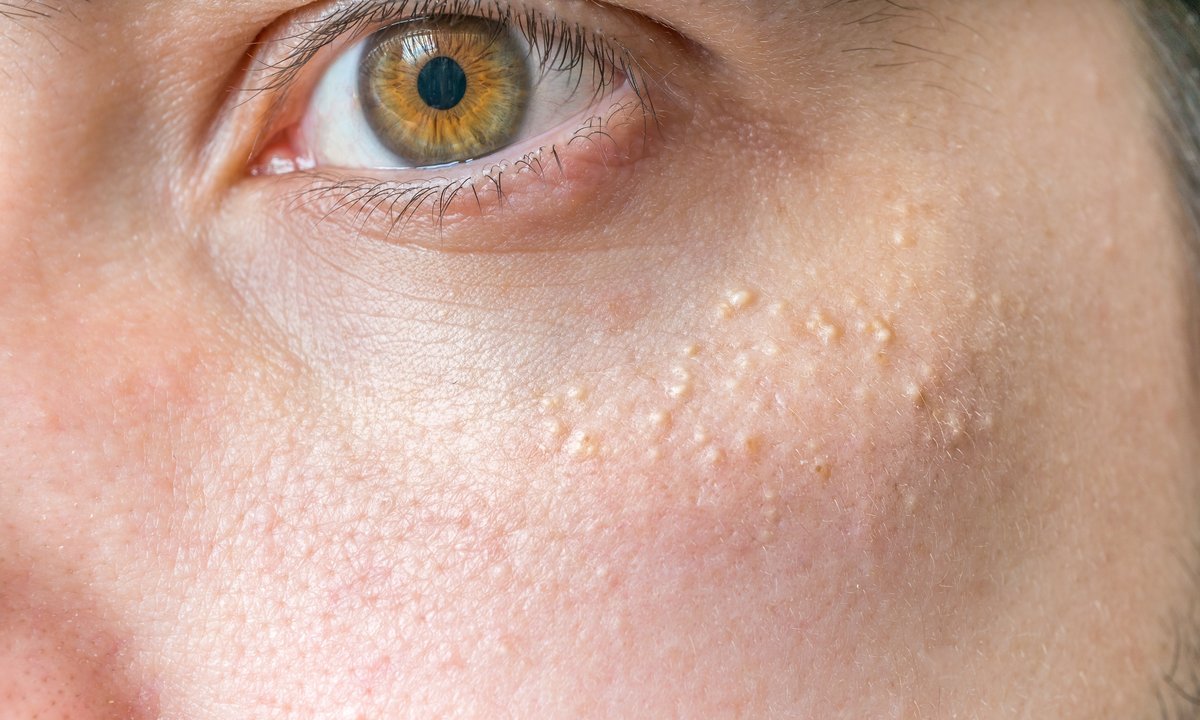 Na policzkach i skroniach widzisz białe grudki? To prosaki. Zobacz skuteczne kosmetyki, które się z nimi rozprawią