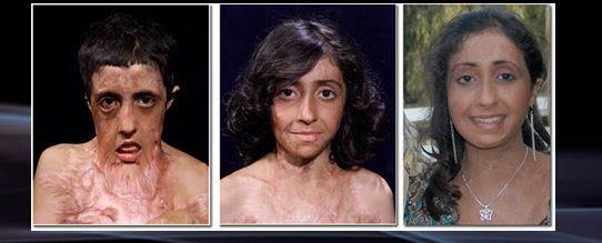 Lekarze dokonali cudu i zmienili wygląd poparzonej kobiety