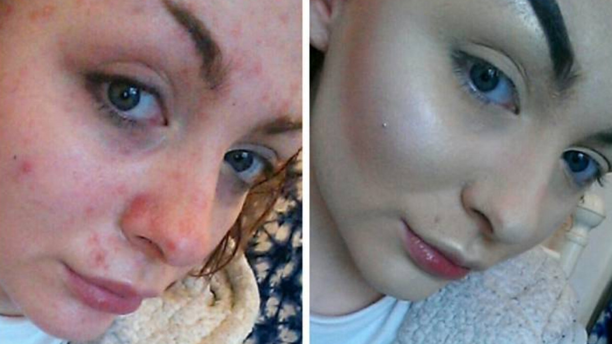 Wizażystka Sophia Ridlington od kilku lat dzieliła się ze swoimi followersami na Instagramie zdjęciami przeróżych make-upów czy charakteryzacji. Całkiem niedawno zaskoczyła ich jednak czymś zupełnie innym - pokazała się bez makijażu, ujawniając chorobę - na którą cierpi od dawna - łuszczycę.
