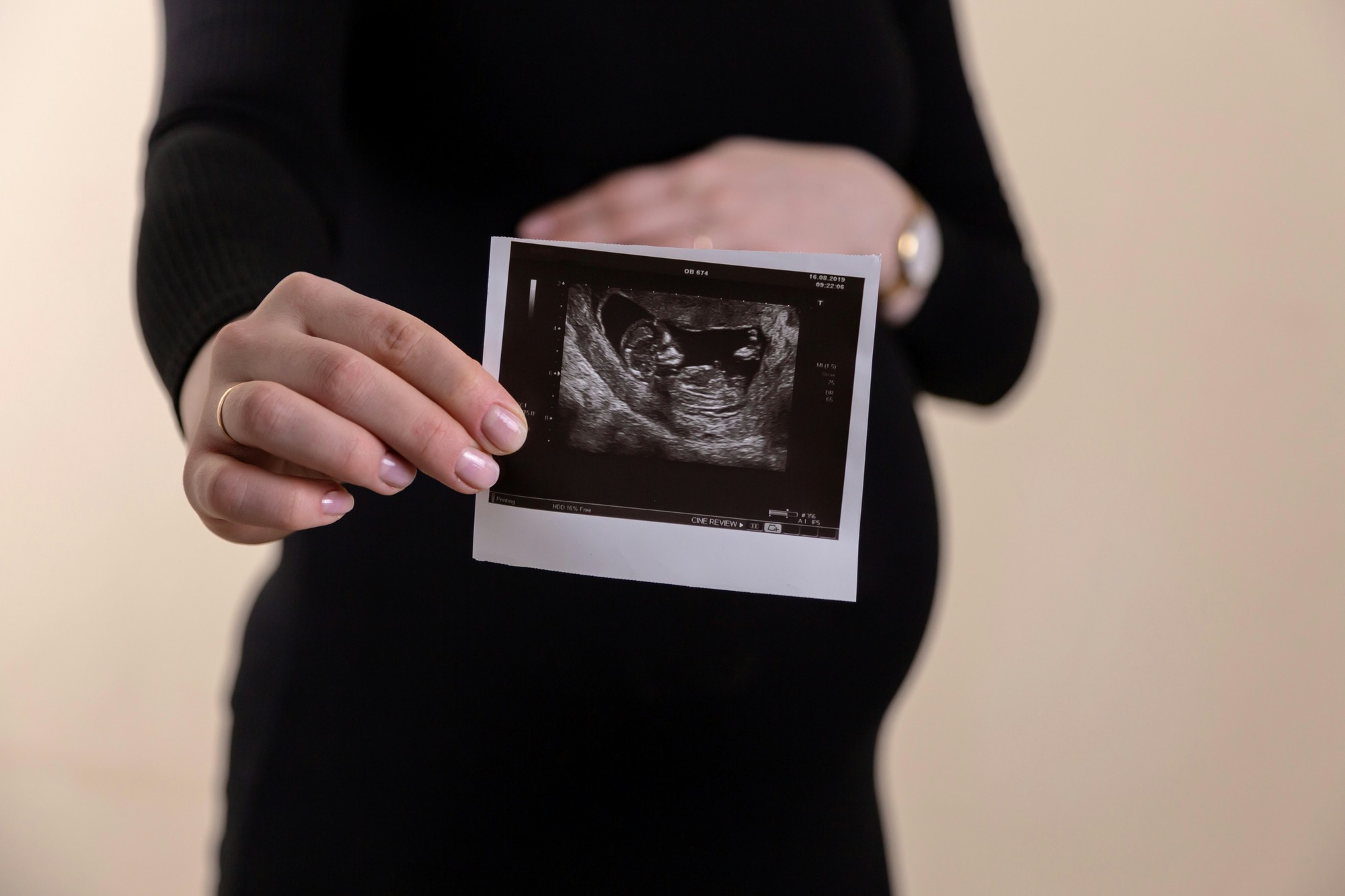 Tehotná žena drží ultrazvukovú snímku svojho nenarodeného dieťaťa. Nový výskum naznačuje, že plod môže reagovať na zívanie matky ešte pred narodením, pričom zvýšená pravdepodobnosť zívnutia sa objavila približne o 90 sekúnd neskôr. (Ilustračný obrázok)