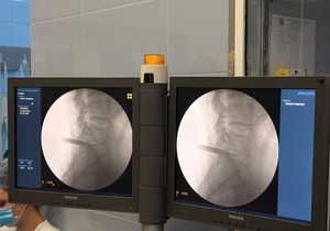 Endoskopska operacija diskus hernije u UKC Vojvodine 