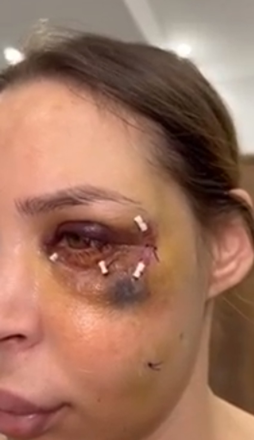 Nataša Šavija nakon operacije