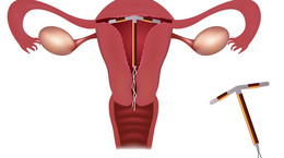 Wkładka domaciczna - czy jest skuteczna? Przeciwwskazania do założenia spirali antykoncepcyjnej