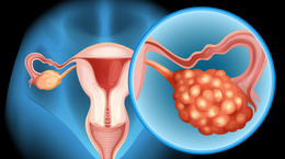 Pacjentki i lekarze na to czekali. Lek na raka jajnika refundowany od stycznia 2022