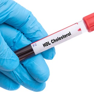 Mit jelent a HDL-koleszterin érték a laborleleten?