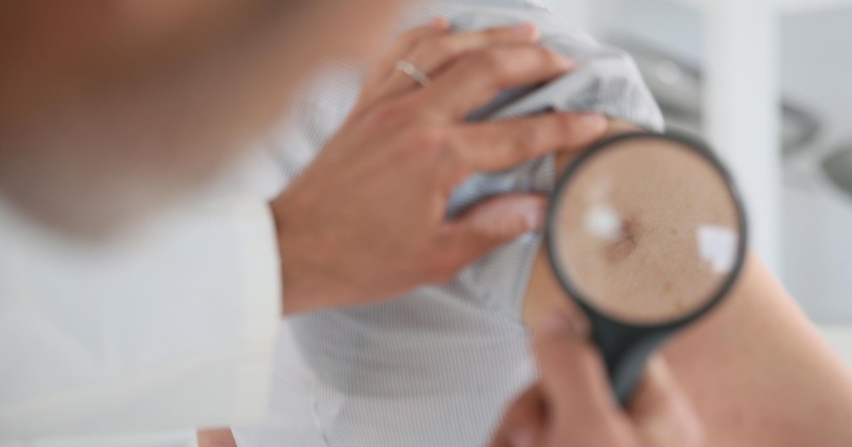 Ta witamina zmniejsza ryzyko nawrotu raka skóry. Dermatolog: przynosi największe efekty