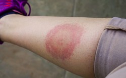 Kiedy ukąszenie kleszcza jest groźne. BORELIOZA: Od objawów po leczenie