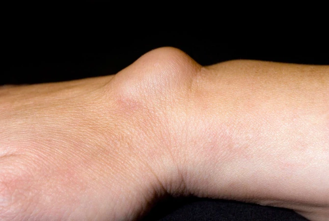 Ovako natečeni zglob je gotovo siguran znak da je u pitanju ganglion