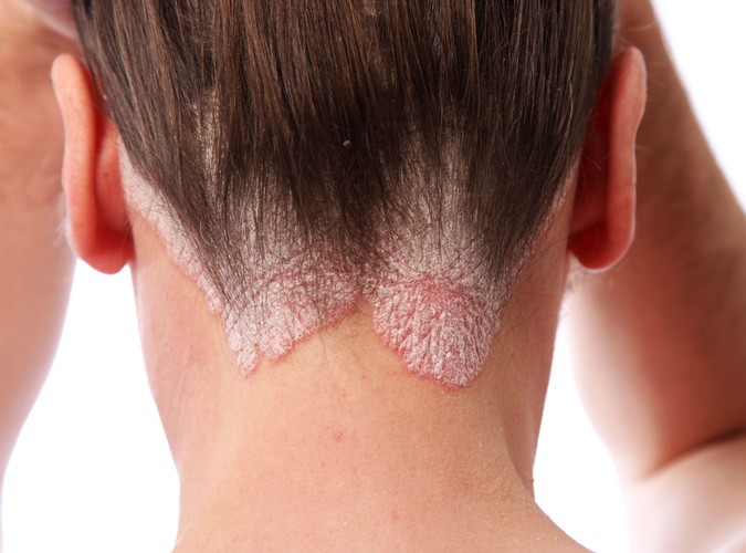 Łuszczyca jest chorobą zakaźną