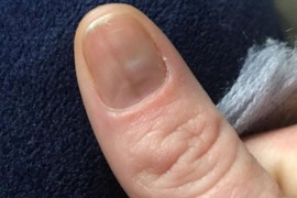 Manikirka je videla moj nokat i panično rekla – ODMAH KOD LEKARA: Kad su otkrili šta je “flekica” zaledila sam se - bila je to NAJOPASNIJA BOLEST