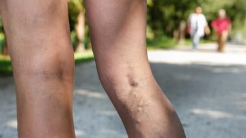 a visszeres ödéma gyógymódjai a varikózisos lábak kezelése népi gyógymódokkal