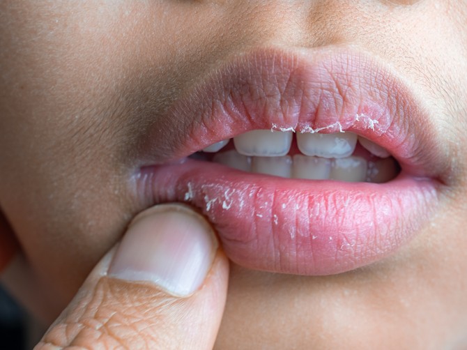 Dermatolog otkriva uzroke suvih i ispucalih usta i kako ih pravilno negovati