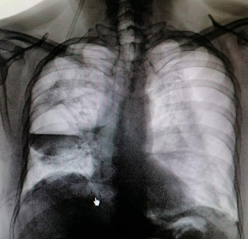 Obostrani pneumotoraks sa apscesnom šupljinom
