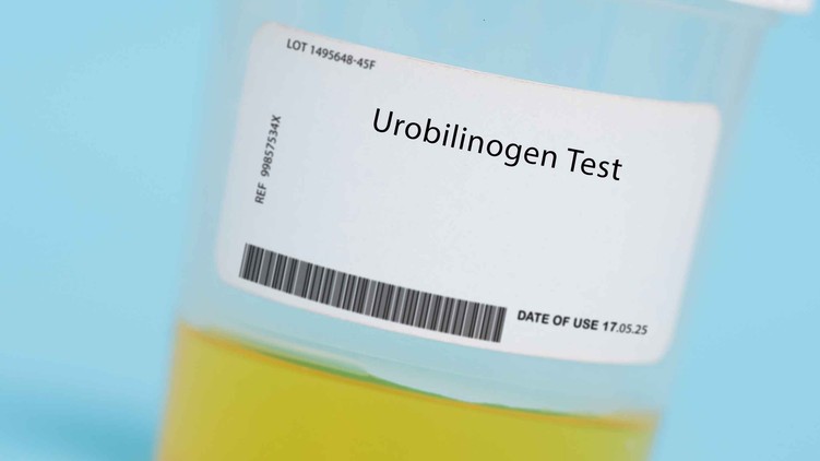 Mit jelent urobilinogén UBG érték laborlelet