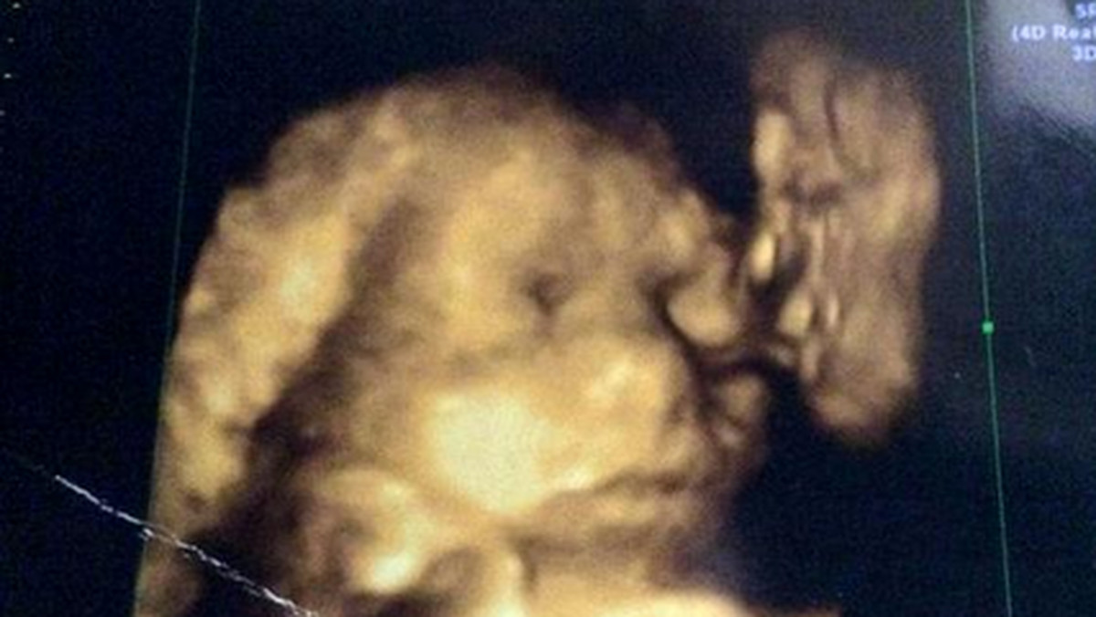 Mieszkanka Wielkiej Brytanii, Jade Hornsby, w 30. tygodniu ciąży poszła na rutynowe badania. Gdy zobaczyła zdjęcie USG była mocno zaskoczona. Dostrzegła na nim profil twarzy swojego zmarłego dziadka - pisze "Mirror".