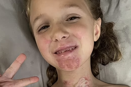 Stavila je OVO U MIKROTALASNU i desila se EKSPLOZIJA zbog koje je dobila OPEKOTINE 3. stepena i završila u komi: Lekari upozoravaju roditelje na OPASNE TIK TOK TRENDOVE