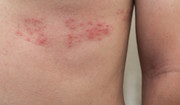 Alergiczne reakcje skórne - co je powoduje?