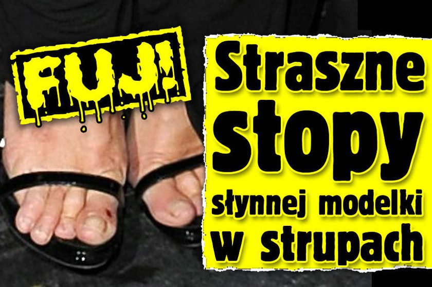 FUJ Straszne stopy słynnej modelki w strupach