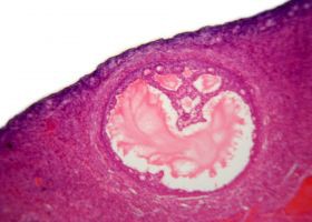 verzesi-rendellenesseg-ovar-d000008E4549c3eeca748