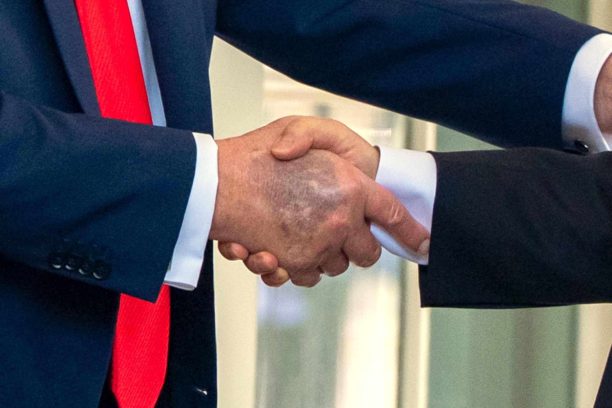 Na rukách prezidenta Donalda Trumpa sa opakovane objavujú modriny. 