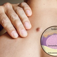 Zavaró kinövések a bőrön - innen tudhatja, hogy fibróma vagy szemölcs okozza