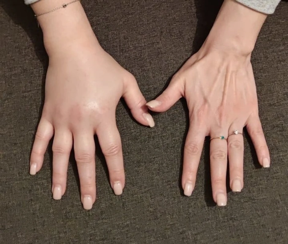 Jovanine ruke prilikom oticanja