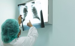 Raport: rak płuca wywołuje co piąty w Europie zgon nowotworowy