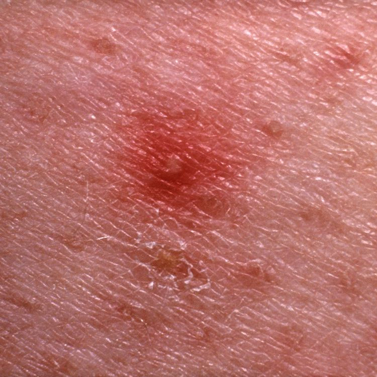 12 Bumps On Your Skin That Are Totally Normal—and You Shouldnt Pop