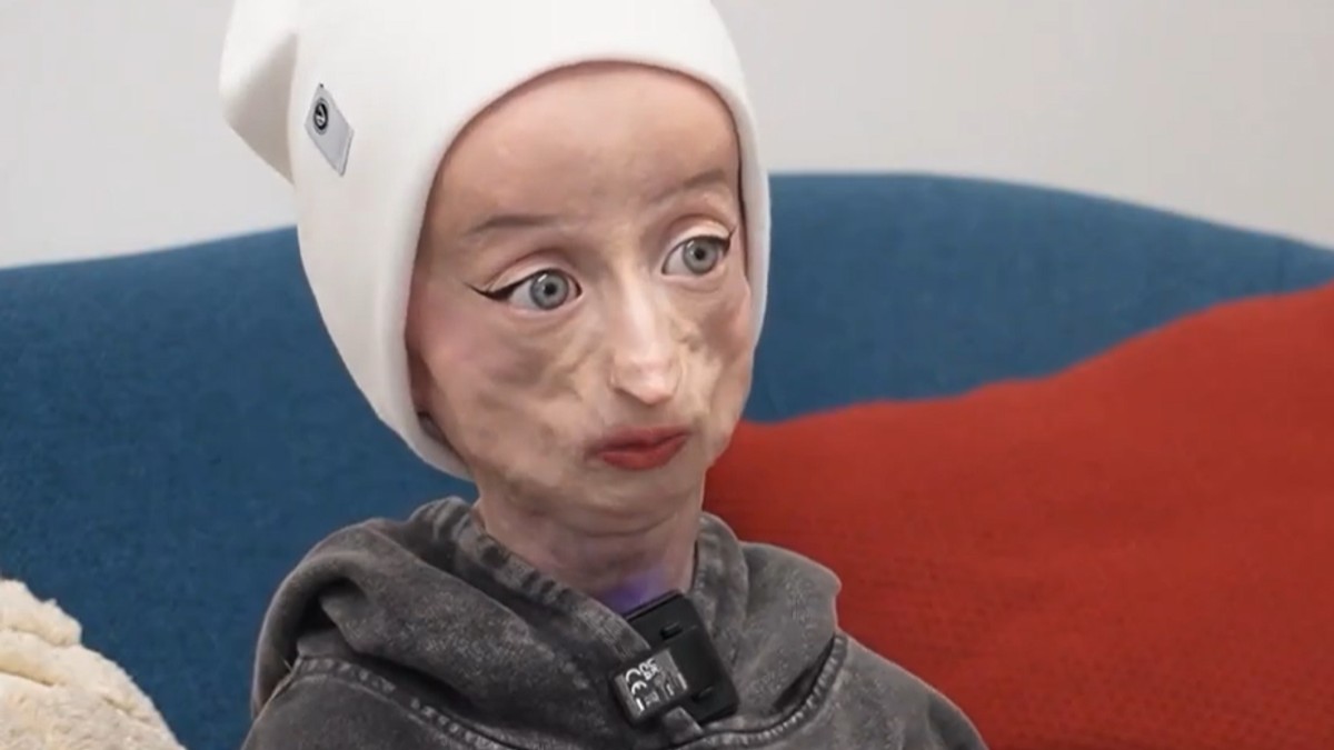 Anja je rođena kao zdrava beba, a sa 17 izgleda kao starica od 80 godina