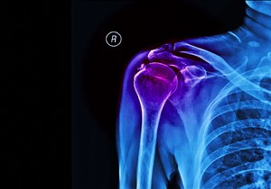 Naslage kalcijuma u tetivama ili mišićima mogu da zahvate bilo koji deo tela, ali najčešće pogađaju rame 