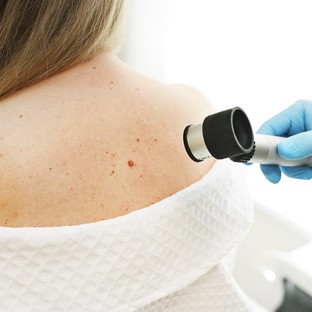 Évente 2500 magyarnál diagnosztizálnak melanomát - ez a szűrés életet menthet