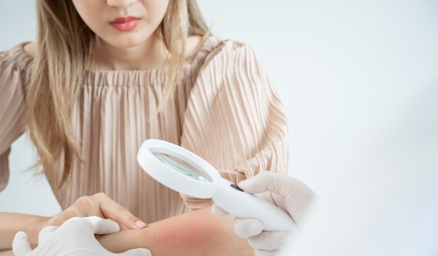 Anafilaksa jaka alergijska reakcija 