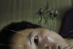 A patient suffering from facial paralysis undergoes acupuncture treatment at a traditional Chinese m