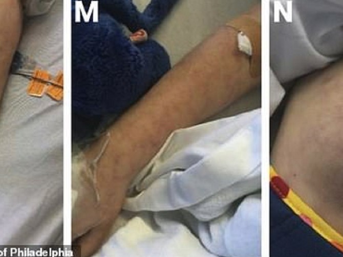 Lekari ustanovili gde se osip izazvan multisistemskim inflamatornim sindromom najčešće javlja kod dece i kako izgleda