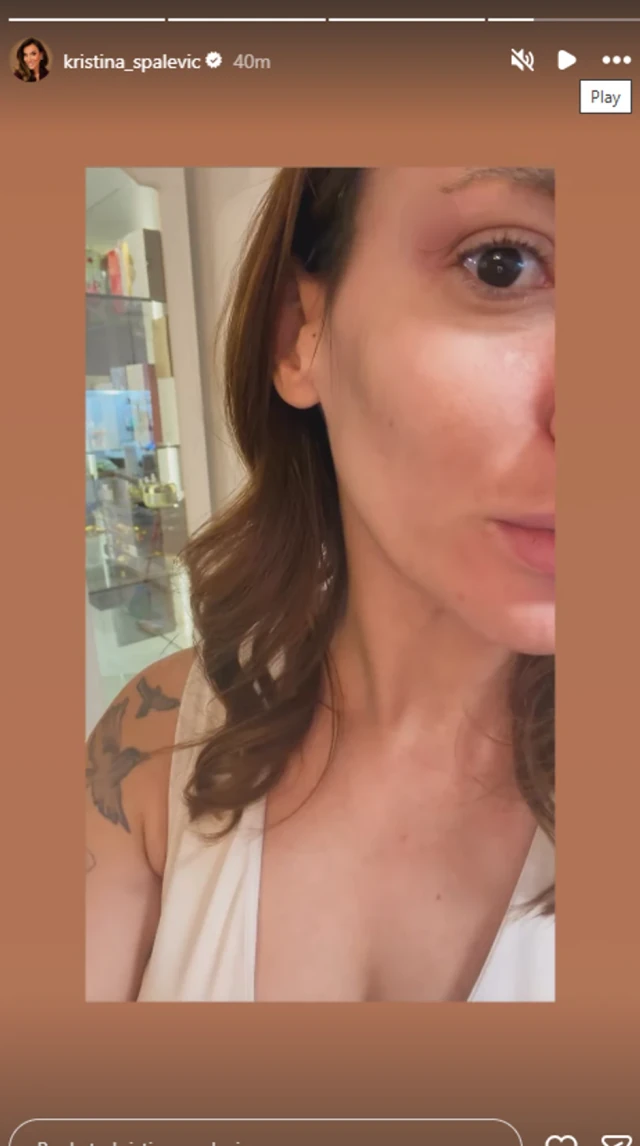 "PRE TRI SEKUNDE ME JE UDARIO, POMODRELO JE I OTEKLO!" Kristina Spalević snimljena sa modricom na licu