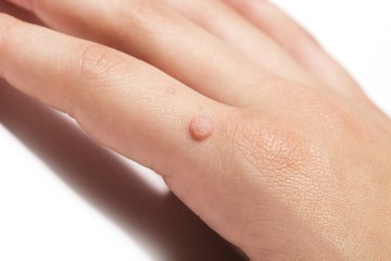 A közönséges, tenyereken és talpakon megjelenő szemölcsöket is és a futószemölcsöket szintén egyes HPV vírusok okozzák.