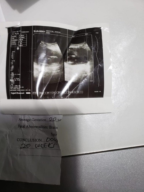 The first ultrasound scan after 20 weeks showed two fetuses