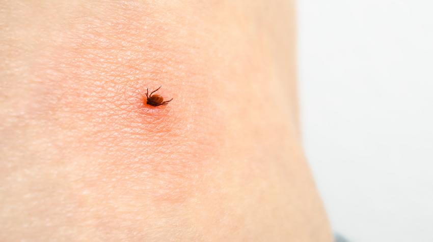 endometriózis, lyme-kór, gyulladás, fáradékonyság, tünet