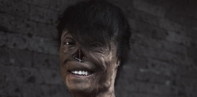 Filipiny. Winson Chen przez 15 minut płonął żywcem. 2 miesiące był w śpiączce. Po ponad stu operacjach i 10 latach odrodził się niczym feniks z popiołów. Opowiada, że nadal posiada to co najważniejsze: „Zachowałem swój umysł, serce, osobowość i... penisa