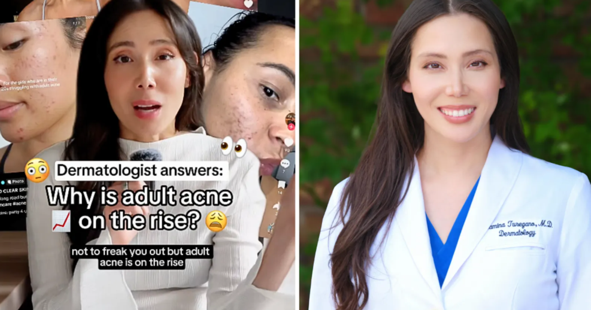 Coraz więcej dorosłych walczy z trądzikiem. Dermatolożka podpowiada, jak z nim walczyć