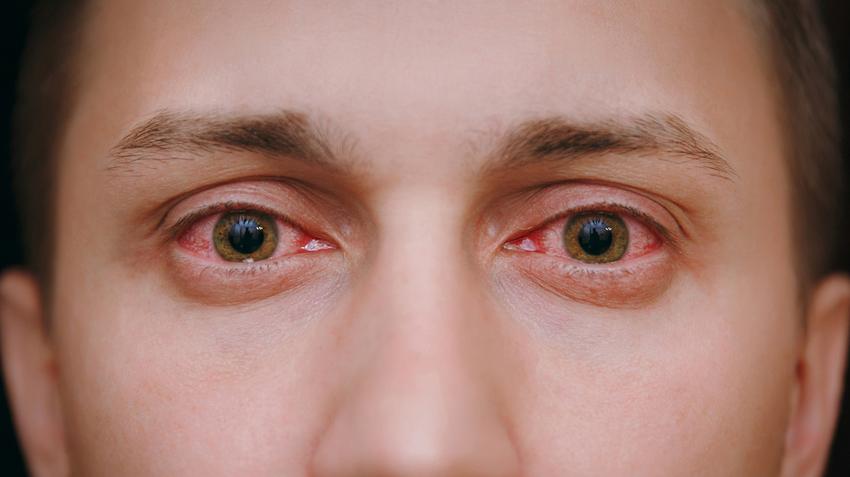 parlagfű, allergia, pollenallegia, szemviszketés, vörös szem, ekcéma,