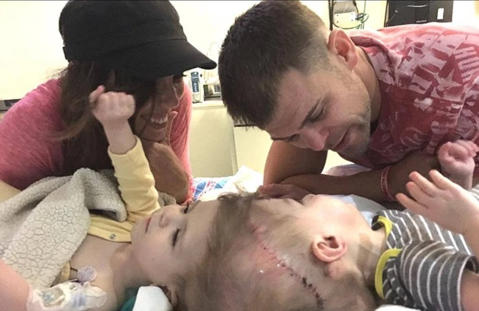 Sijamski blizanci pre operacije