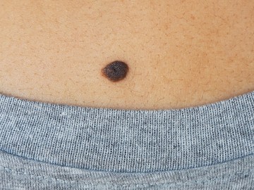 melanóma, bőrrák, bőrdaganat, anyajegy, noduláris melanoma