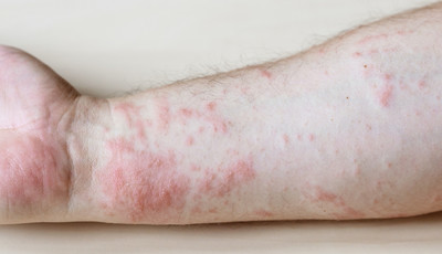 Jak rozpoznać wysypkę alergiczną? Przyczyny, objawy i leczenie alergii  skórnych