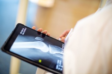 A csontritkulás (osteoporosis) kialakulását két tényező befolyásolja: az élet első 40 éve során megvalósuló csont-felépülés, valamint az ezt követő csont leépülés mértéke.