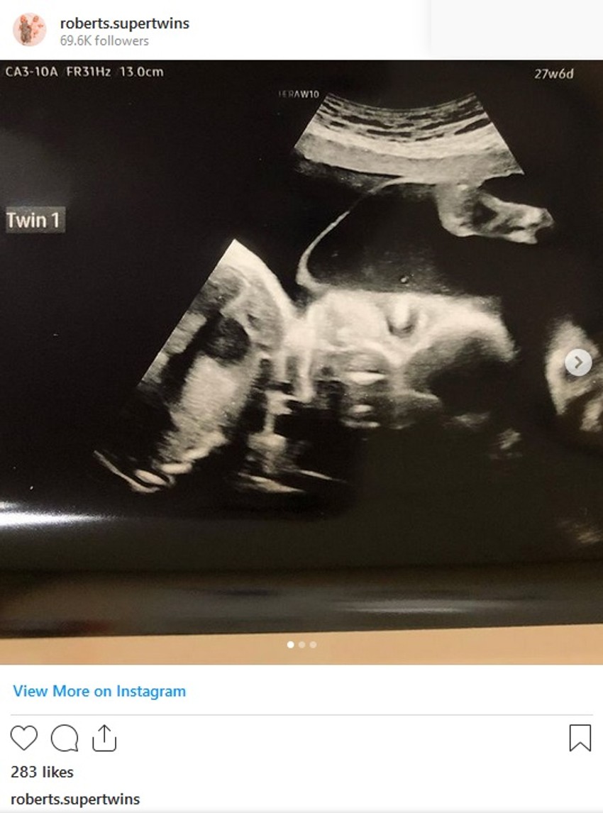 Rebekin snimak sa ultrazvuka