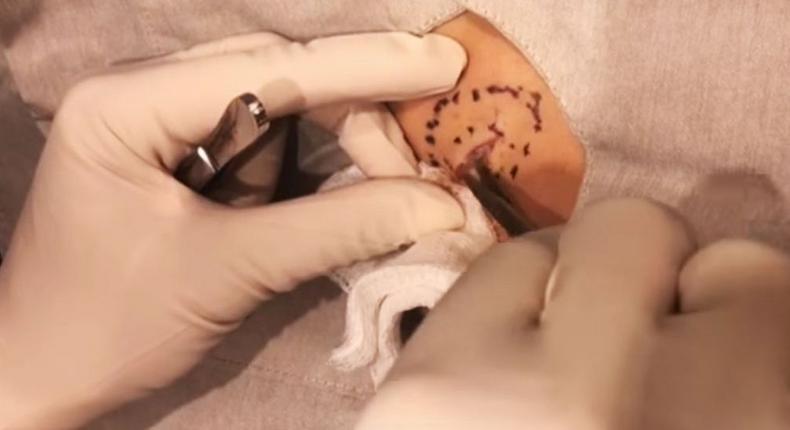 Dr. Pimple Popper's Latest Video Is Truly Vile